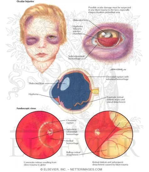 Watermarked preview of labeled image: Child Abuse: Ocular Injuries