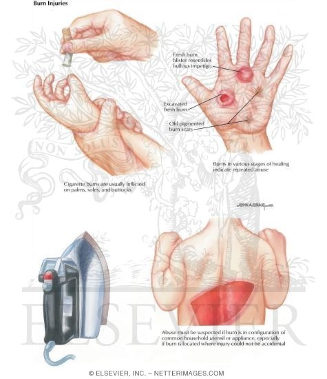 Watermarked preview of labeled image: Child Abuse: Burn Injuries