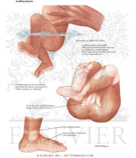 Watermarked preview of labeled image: Child Abuse: Scalding Injuries