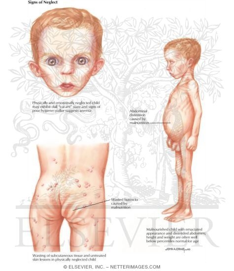 Watermarked preview of labeled image: Child Abuse: Signs of Neglect