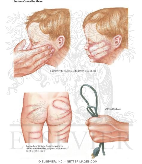 Watermarked preview of labeled image: Child Abuse: Bruises Caused By Abuse