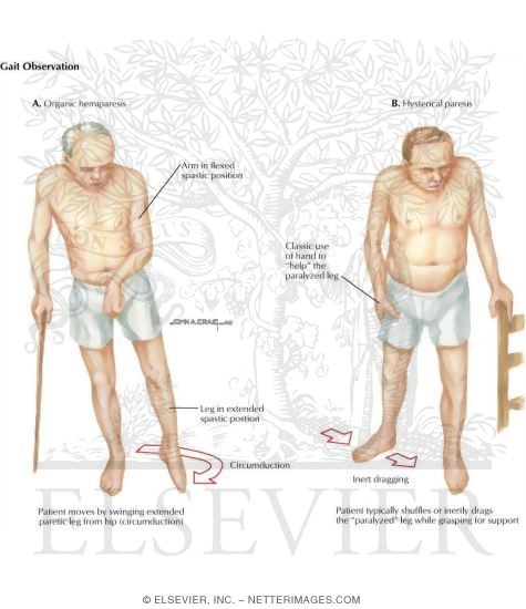 Hysterical Conversion Reactions: Patient Observation and Gait Observation