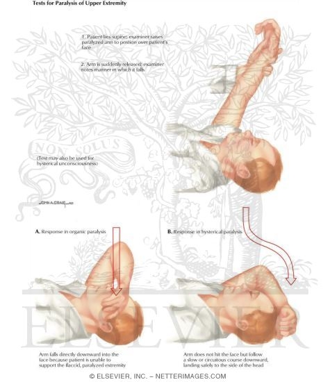 Hysterical Conversion Reactions: Test for Paralysis of the Upper Extremity