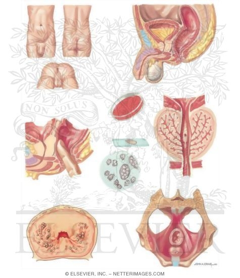 Watermarked preview of unlabeled image: Diseases of Prostate: Prostate Infections