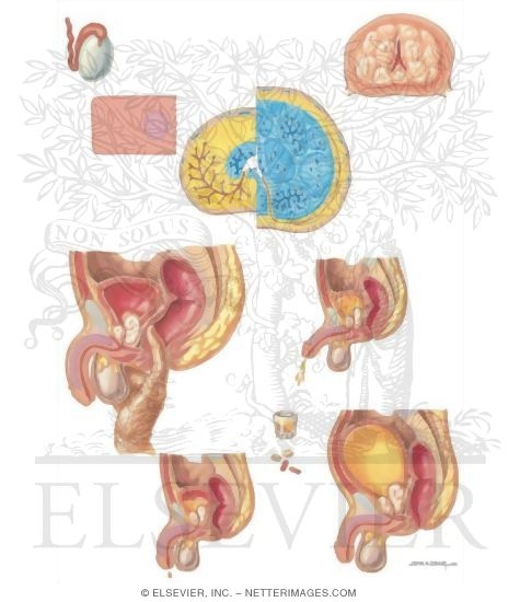 Watermarked preview of unlabeled image: Diseases of Prostate: Benign Prostatic Hypertrophy (BPH)