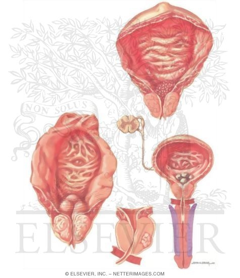 Watermarked preview of unlabeled image: Diseases of Prostate: Differential Diagnosis of Overflow Obstruction