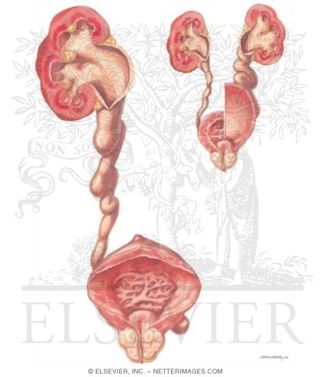 Watermarked preview of unlabeled image: Diseases of Prostate: Diseases of Overflow Obstruction