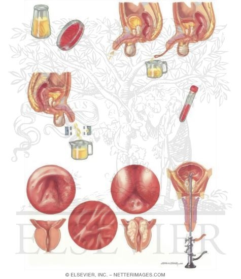 Watermarked preview of unlabeled image: Diseases of Prostate: Evaluation of Overflow Obstruction