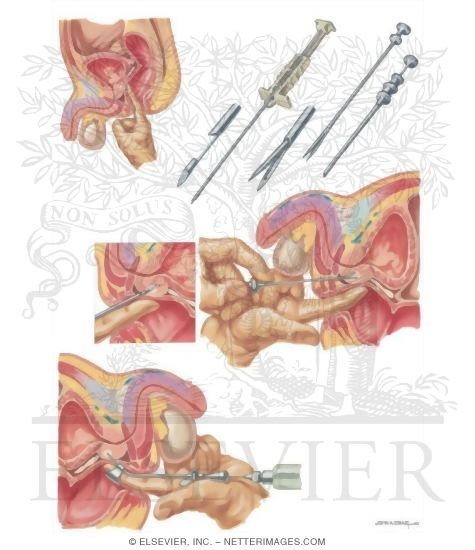 Watermarked preview of unlabeled image: Diseases of Prostate: Diagnosis of Prostate Lesion