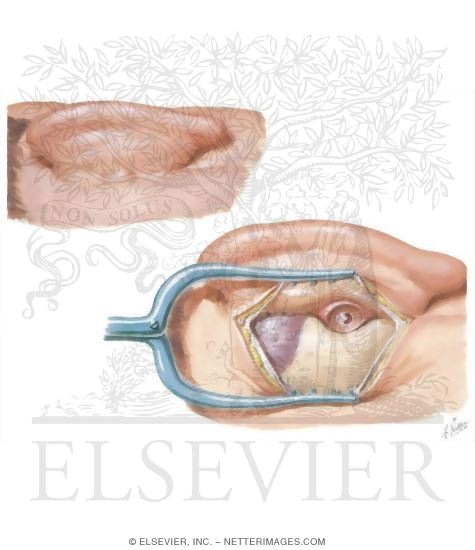 Postauricular Tympanoplasty and Mastoidectomy
