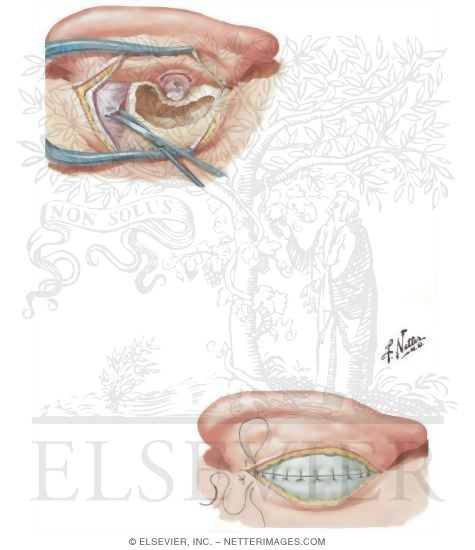 Postauricular Tympanoplasty and Mastoidectomy