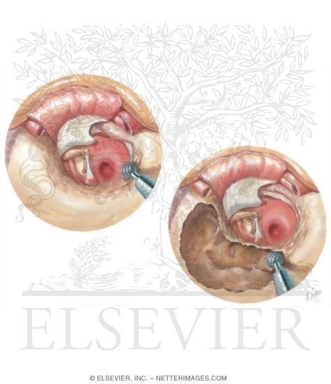 Postauricular Tympanoplasty and Mastoidectomy