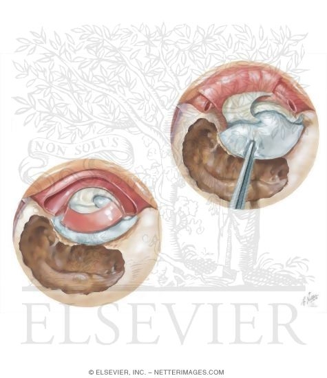 Postauricular Tympanoplasty and Mastoidectomy
