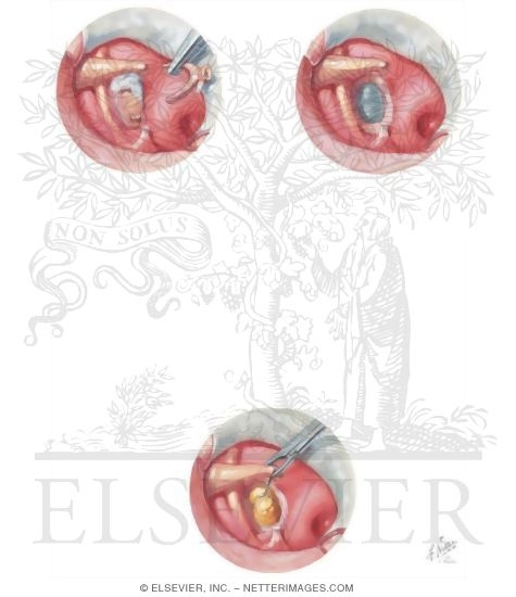 Stapedectomy