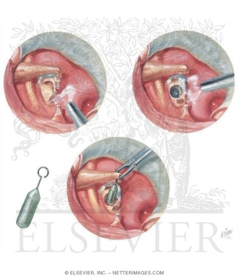 Watermarked preview of unlabeled image: Laser Stapedotomy