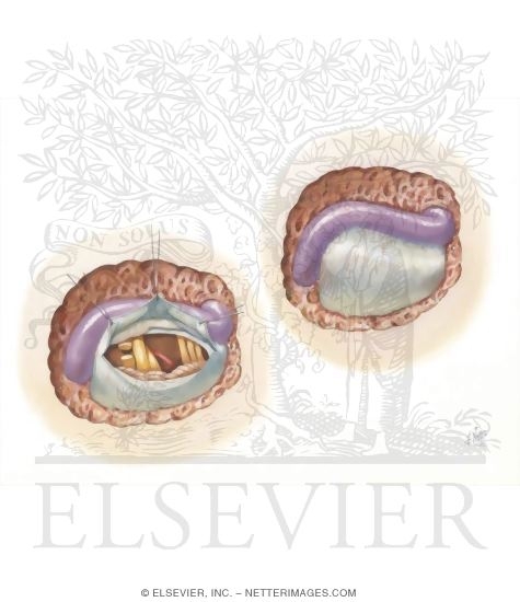 Vestibular Nerve Section