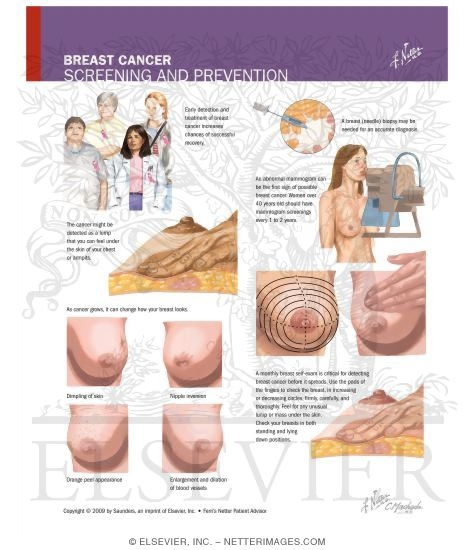 Watermarked preview of labeled image: Breast Cancer Screening and Prevention