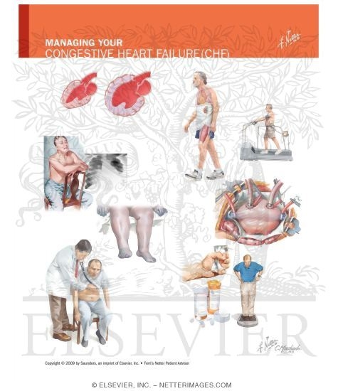 Watermarked preview of unlabeled image: Managing Your Congestive Heart Failure
