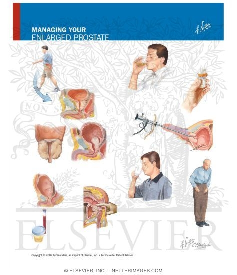 Watermarked preview of unlabeled image: Managing Your Enlarged Prostate
