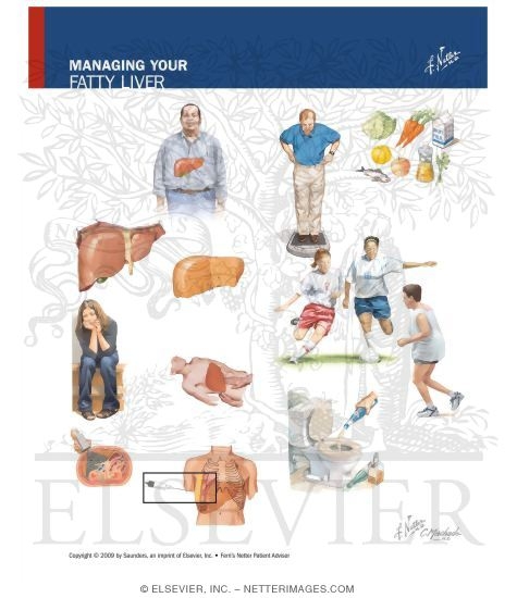 Watermarked preview of unlabeled image: Managing Your Fatty Liver