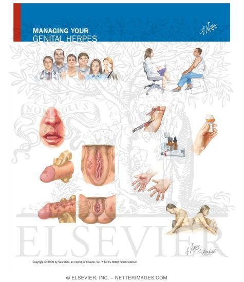 Watermarked preview of unlabeled image: Managing Your Genital Herpes