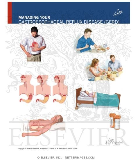 Watermarked preview of unlabeled image: Managing Your Gastroesophageal Reflux Disease (GERD)