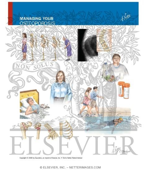 Watermarked preview of unlabeled image: Managing Your Osteoporosis