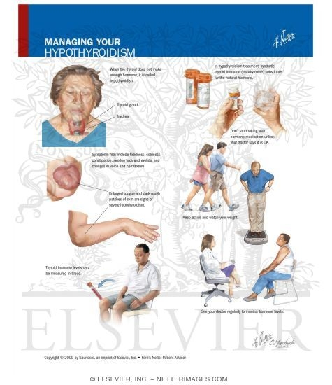 Watermarked preview of labeled image: Managing Your Hypothyroidism