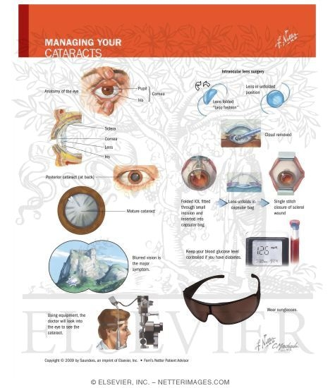 Watermarked preview of labeled image: Managing Your Cataracts