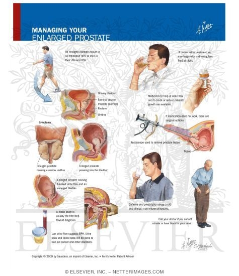 Watermarked preview of labeled image: Managing Your Enlarged Prostate