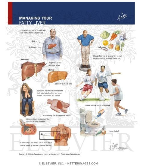 Watermarked preview of labeled image: Managing Your Fatty Liver