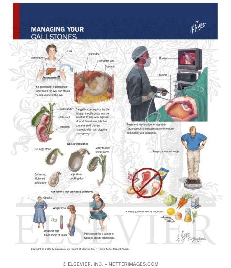 Watermarked preview of labeled image: Managing Your Gallstones