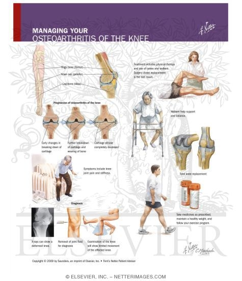 Watermarked preview of labeled image: Managing Your Osteoarthritis of the Knee