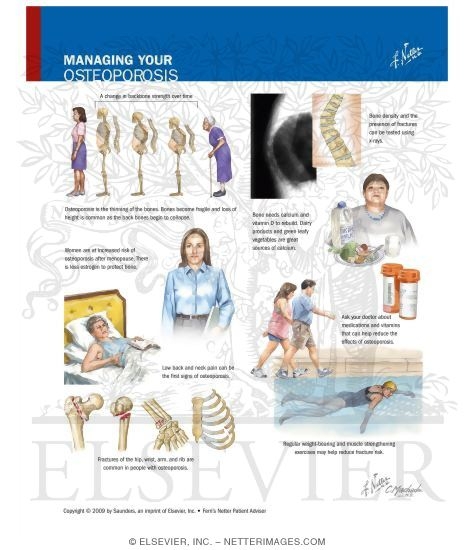 Watermarked preview of labeled image: Managing Your Osteoporosis