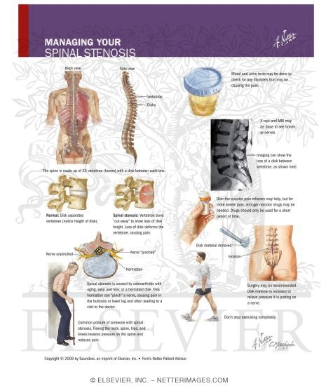 Watermarked preview of labeled image: Managing Your Spinal Stenosis