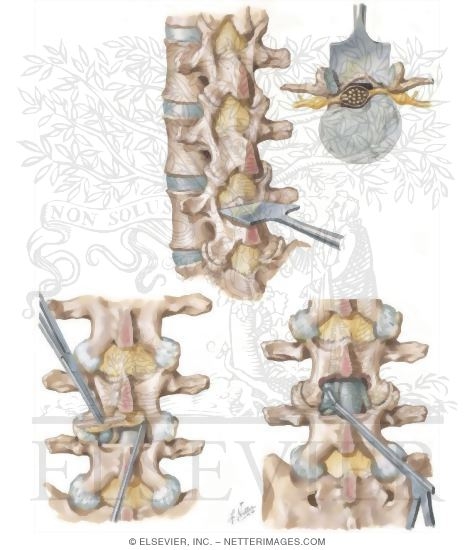 Watermarked preview of unlabeled image: Removal of Herniated Disc: Fusion