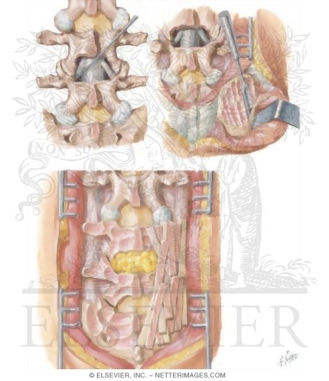 Watermarked preview of unlabeled image: Removal of Herniated Disc: Fusion