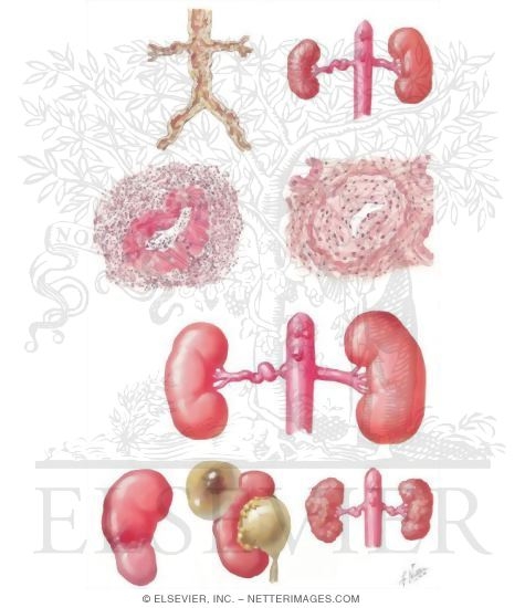 Watermarked preview of unlabeled image: Renin-Related Hypertension