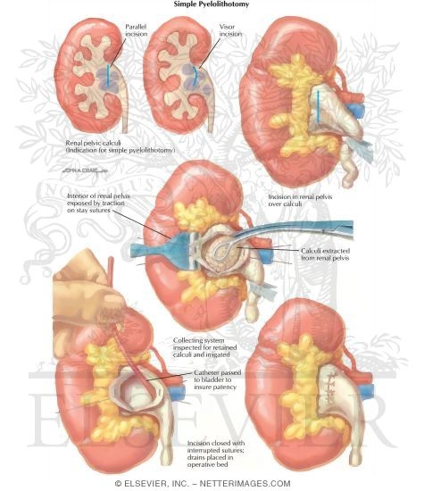 Watermarked preview of labeled image: Urinary Calculi: Simple Pyelolithotomy