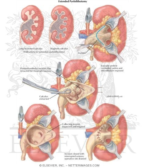 Urinary Calculi: Extended