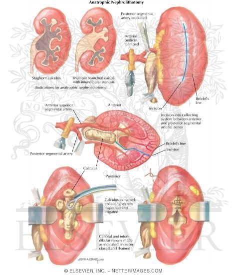 Urinary Calculi: Anatrophic Nephrolithotomy