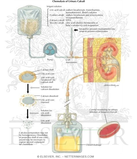 Urinary Calculi: Chemolysis of Urinary Calculi