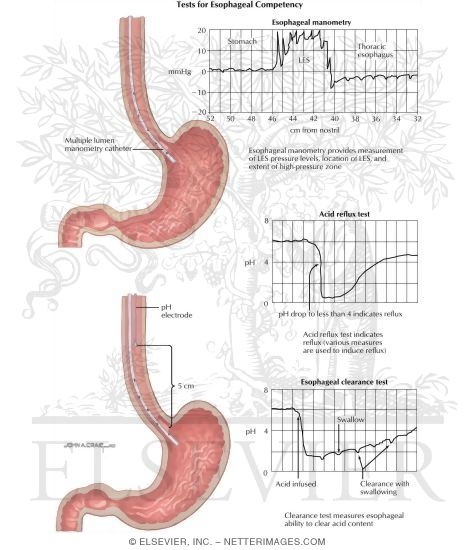 Watermarked preview of labeled image: Hiatus Hernia: Tests for Esophageal Competency