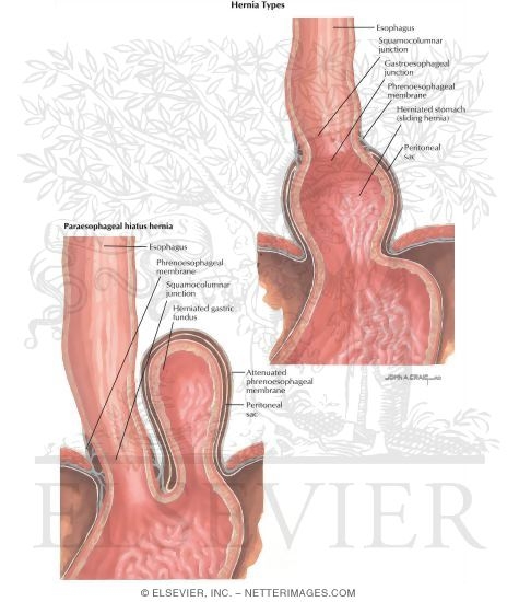Watermarked preview of labeled image: Hiatus Hernia: Hernia Types
