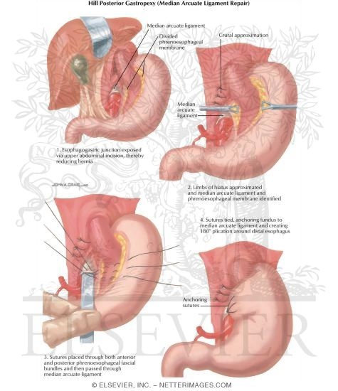 Hiatus Hernia: Hill Posterior Gastropexi (median Arcuate Ligament Repair)