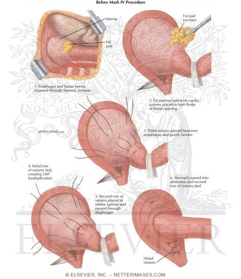 Hiatus Hernia: Belsey Mark IV Procedure