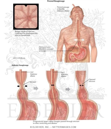 Hiatus Hernia: Peroral Bougienage