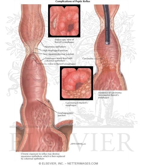 Watermarked preview of labeled image: Hiatus Hernia: Complications of Peptic Reflux
