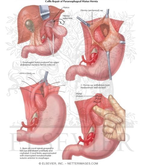Watermarked preview of labeled image: Hiatus Hernia: Collis Repair of Paraesophageal Hiatus Hernia