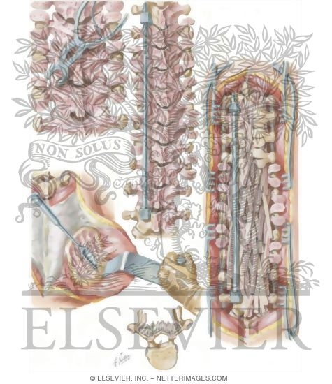 Watermarked preview of unlabeled image: Spinal Fusion